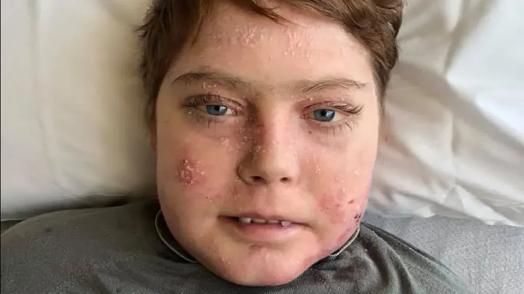Butterfly Skin Disease: Understanding the Rare Condition That Makes Skin Fragile 2 Butterfly Skin Disease