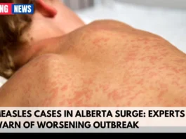 Measles Cases in Alberta Surge