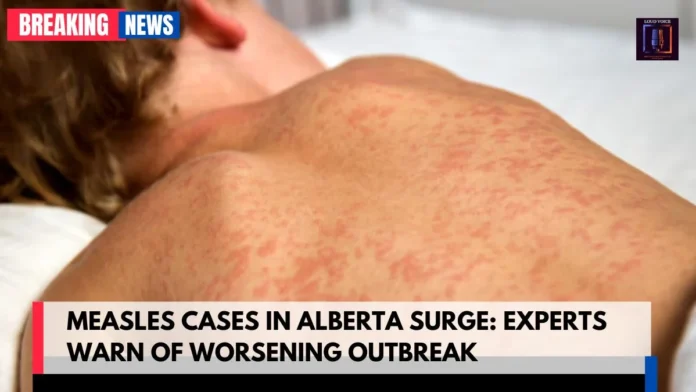 Measles Cases in Alberta Surge Measles Cases in Alberta Surge